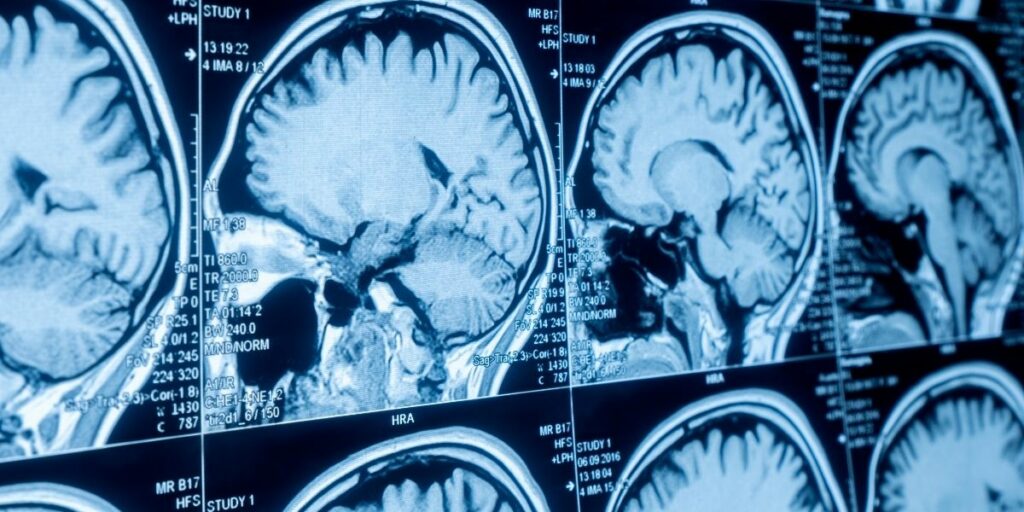 Images IRM du cerveau pour illustrer effets de la psilocybine sur le cerveau et les circuits de la sérotonine.